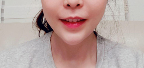 [피부] gus0311 - 필러,리프팅