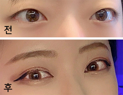 [눈] 지붕S2 - 윗트임, 눈매교정