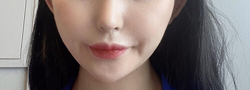 [피부] 다굥다굥 - 울쎼라, 에어젯