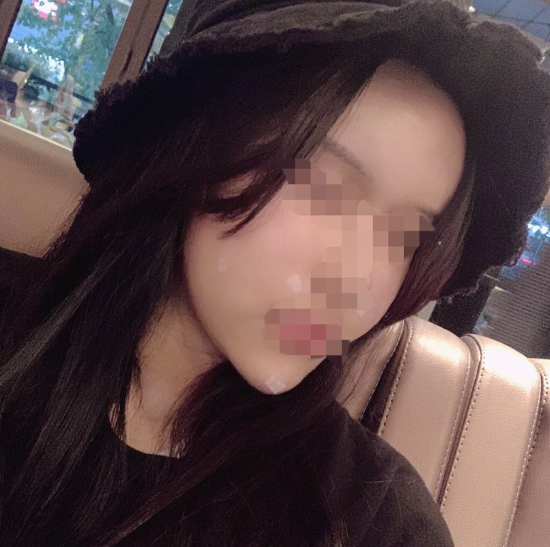 [안티에이징] 강남좋아 - 지방이식