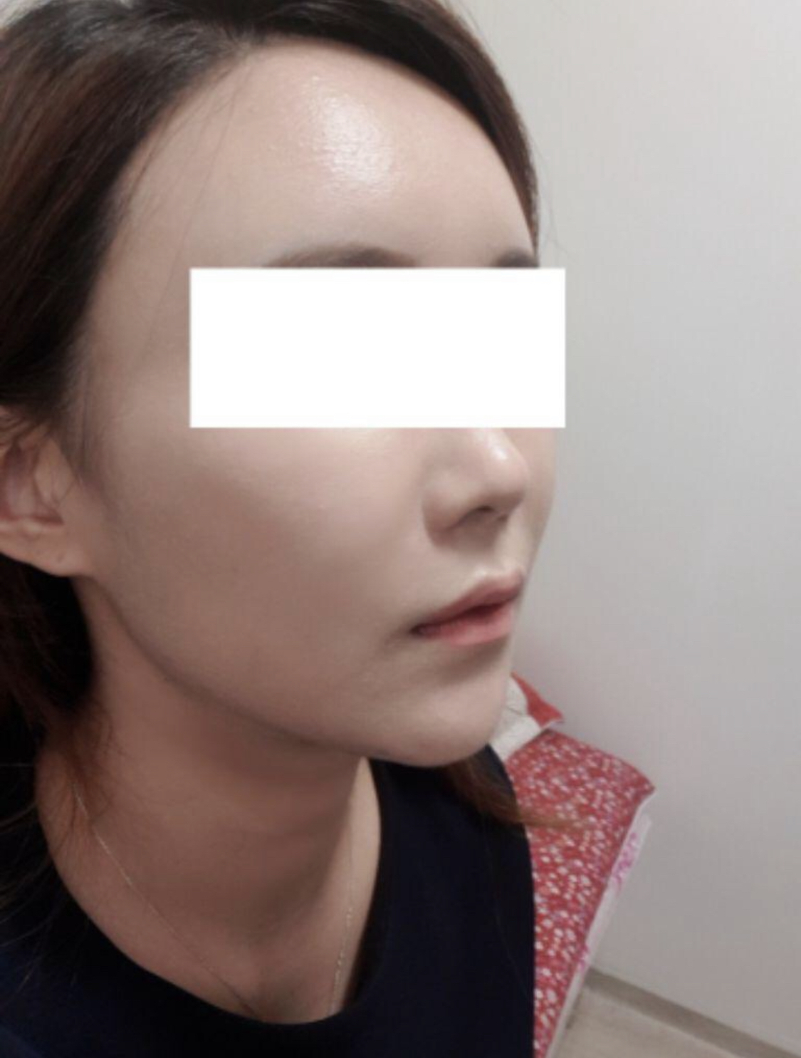 [안티에이징] 까렁이 - 풀페이스지방이식