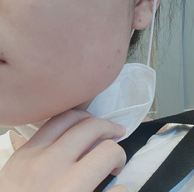 [쁘띠] seoul - 턱보톡스