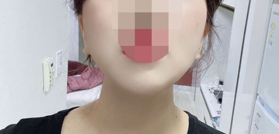 [지방흡입] 비마스크해 - 얼굴지방흡입