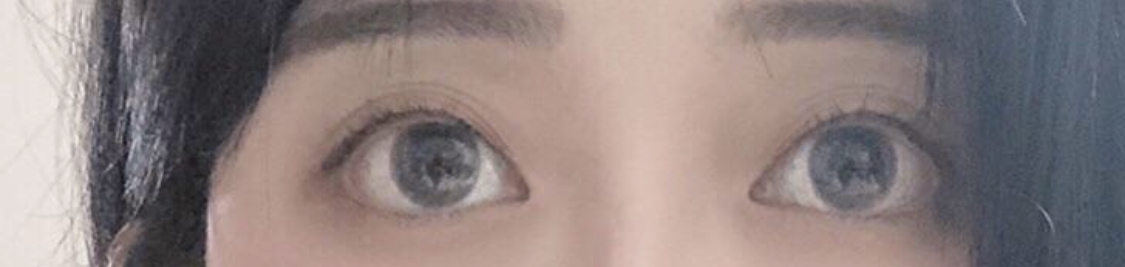 [눈] Hitwo - 눈매교정,매몰