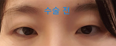 [눈] 직진분사식 - 눈