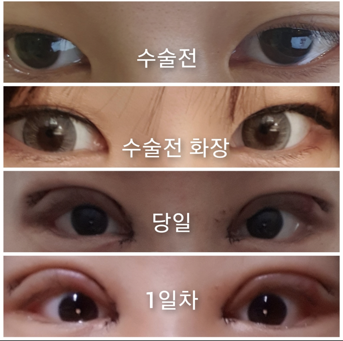 [눈] 고기영 - 쌍꺼풀,윗트임,밑트임