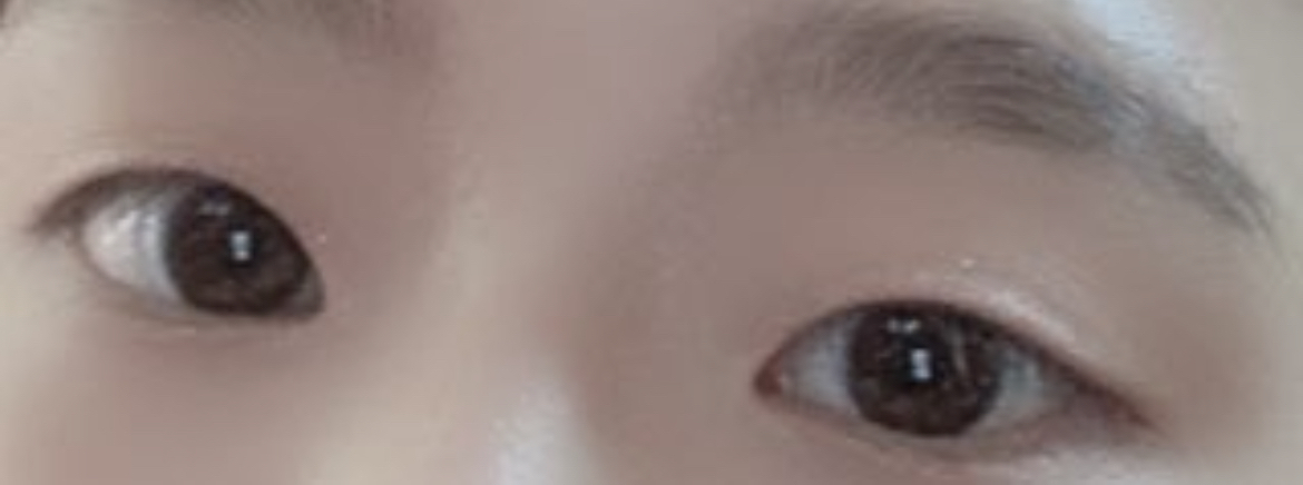 [눈] 이soo - 매몰,앞트임