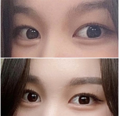 [눈] 연듀두 - 쌍꺼풀, 트임