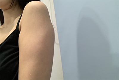 [지방흡입] 꿀랄릴 - 팔, 부유방 지방흡입