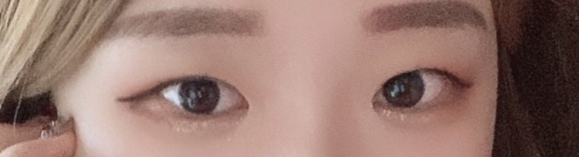 [눈] 룰류우 - 눈재수술