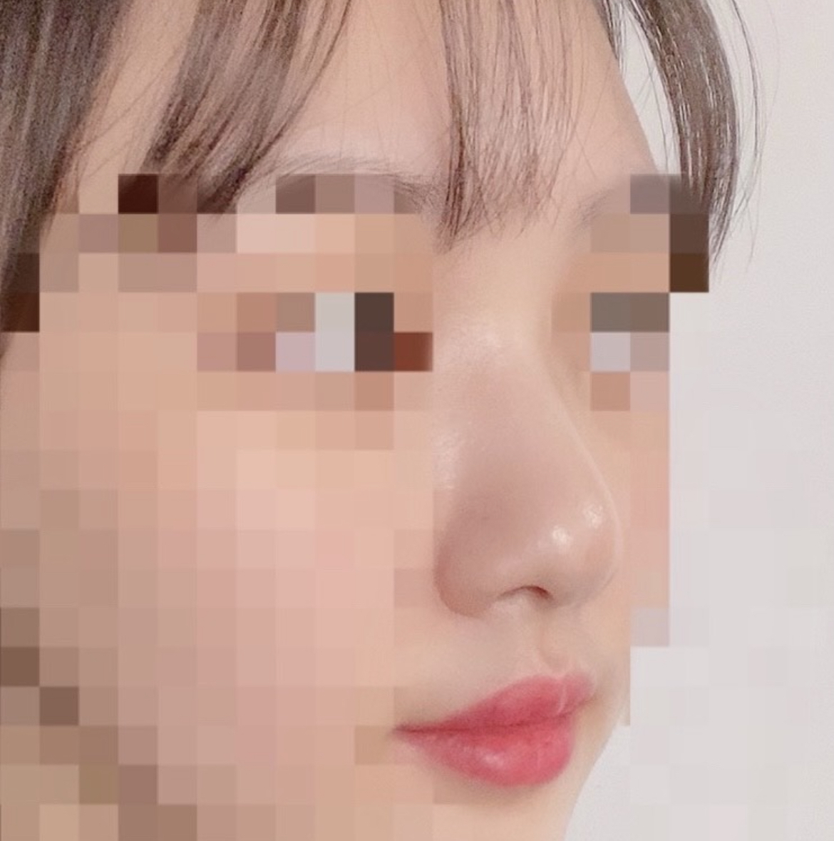 [코] 롱다랑사 - 코성형