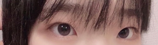 [눈] 쿠로미s2 - 쌍꺼풀(절개), 앞트임