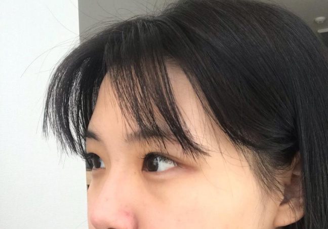 [눈] 응앙응 - 쌍꺼풀(자연유착), 윗트임