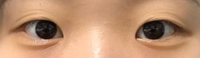 [눈] 딸기내놔 - 앞트임,눈매교정