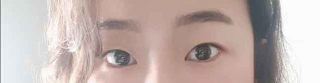 [눈] 라비라비옹 - 쌍꺼풀(절개)