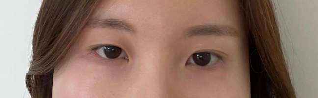 [눈] wyn - 앞트임, 눈매교정