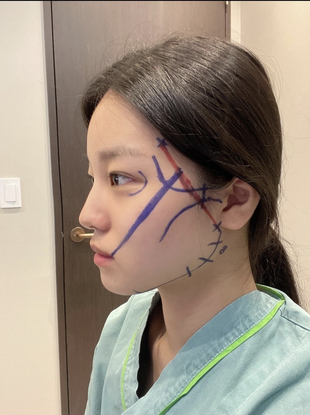 [안면윤곽] 광주공주공주 - 광대,턱끝,사각턱