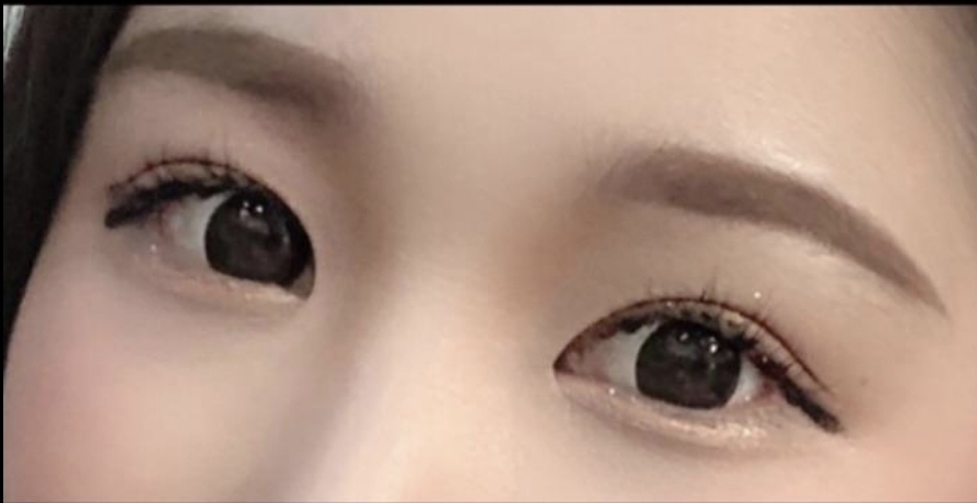 [눈] sidhd22 - 뒤트임,밑트임