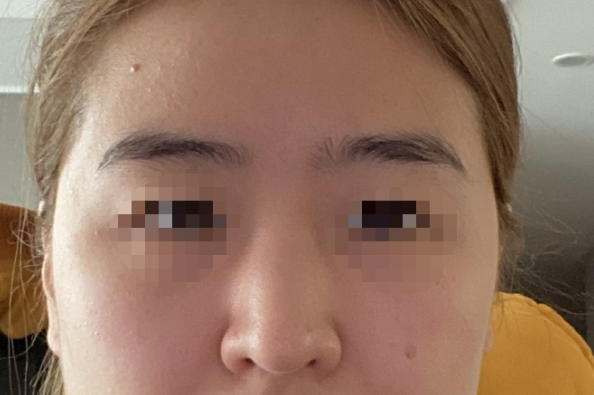 [코] 명지스 - 코,지방이식