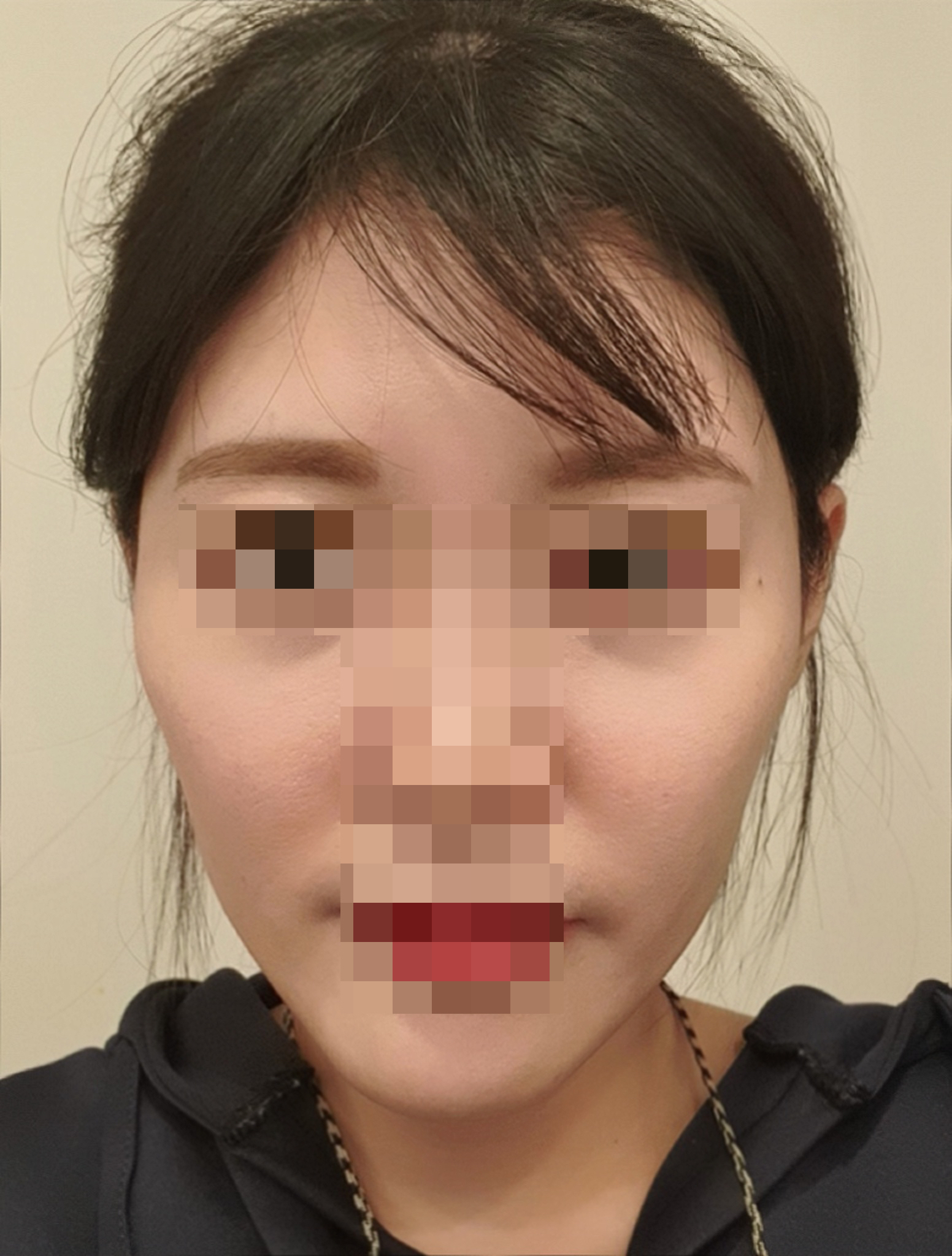 [안면윤곽] 촉촉한나라의쪼꼬칩쿠키 - 안면윤곽