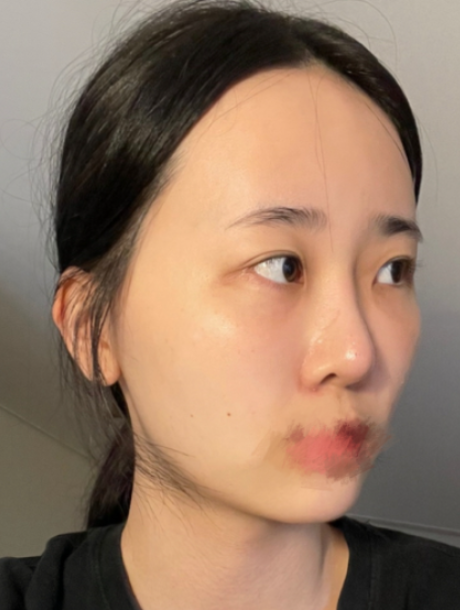 [눈] 곰인형 - 눈,윤곽,지방이식