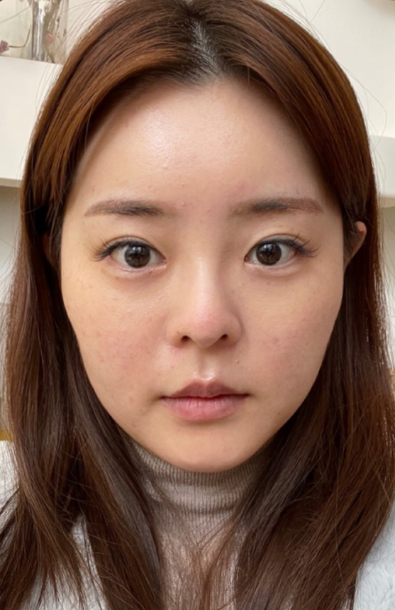 [눈] 토끼야 - 눈, 코, 윤곽, 얼굴지방흡입