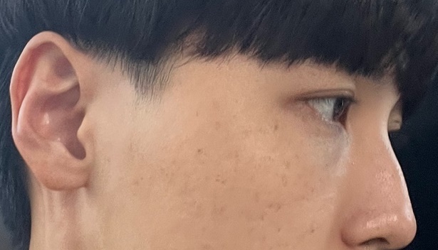 [안면윤곽] 두달차임 - 눈,코,윤곽