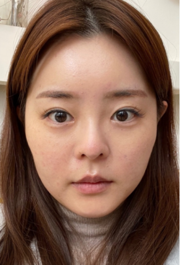 [코] 밍아밍어 - 눈, 코, 얼굴지방흡입