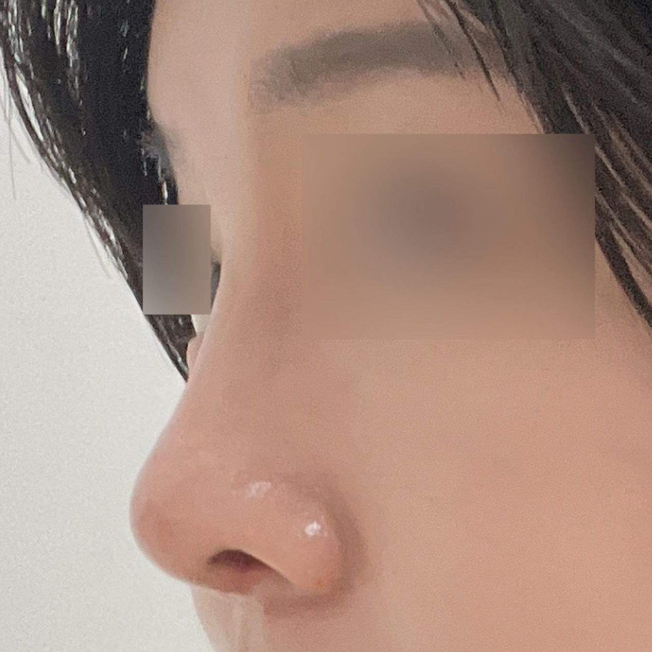 들창코 수술 했습니다~!