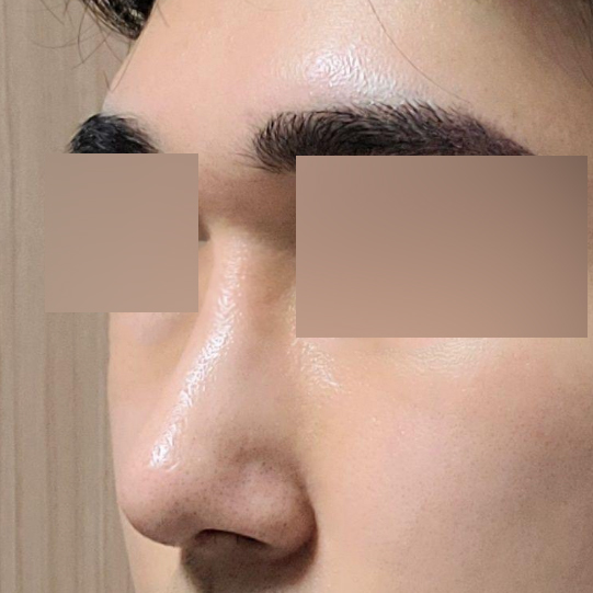 코 한 달 차 후기입니다