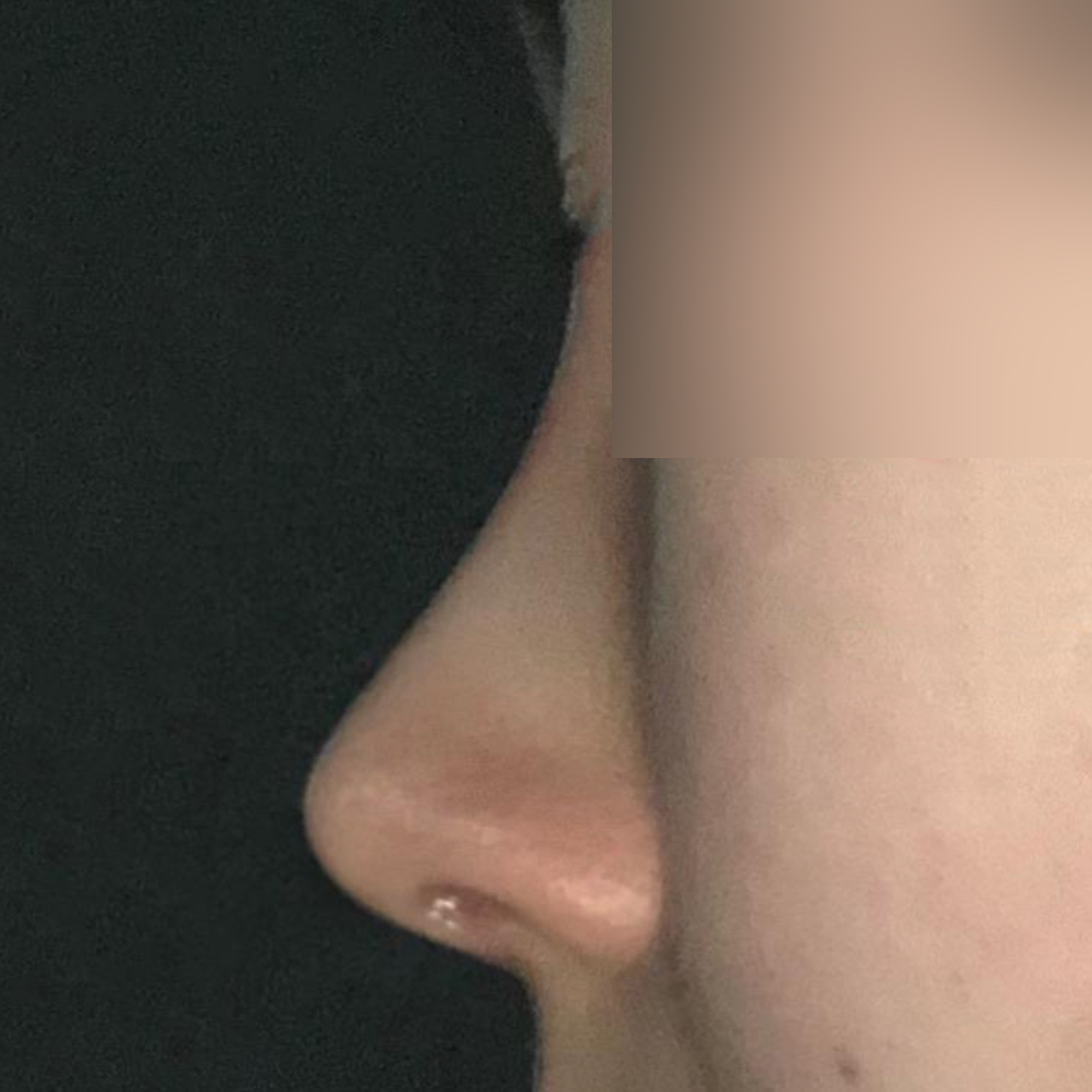 서승조 원장님께 코수술 받은지 1달차에요!