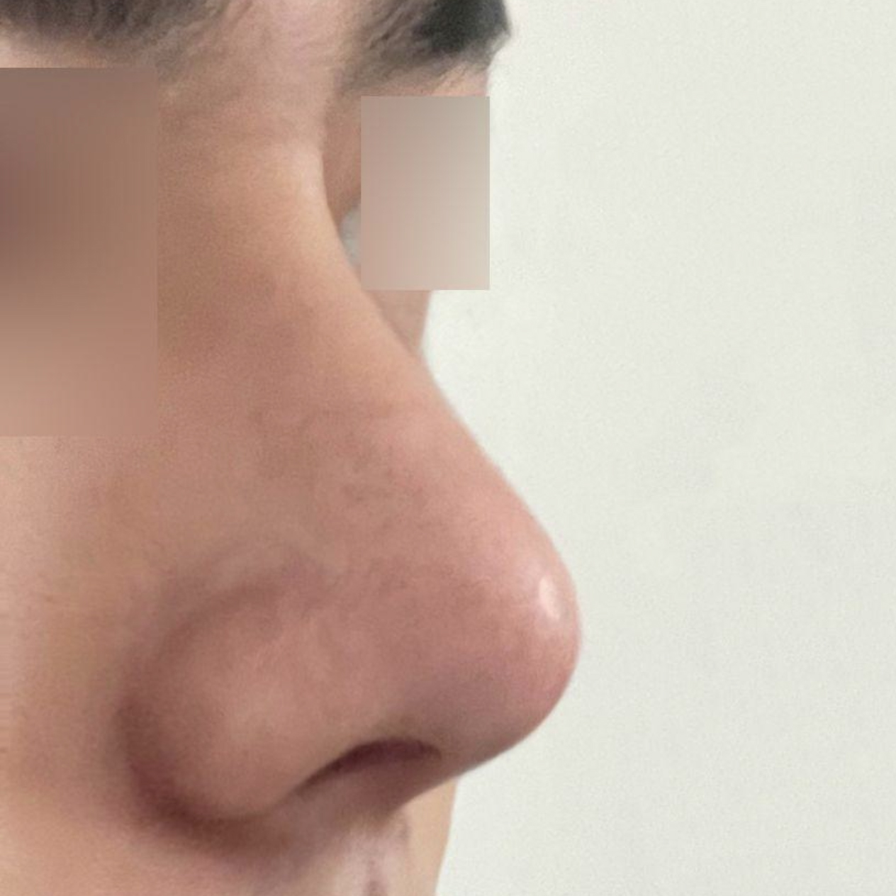 심정환 원장님께 수술 받은지 1달 됐습니다.