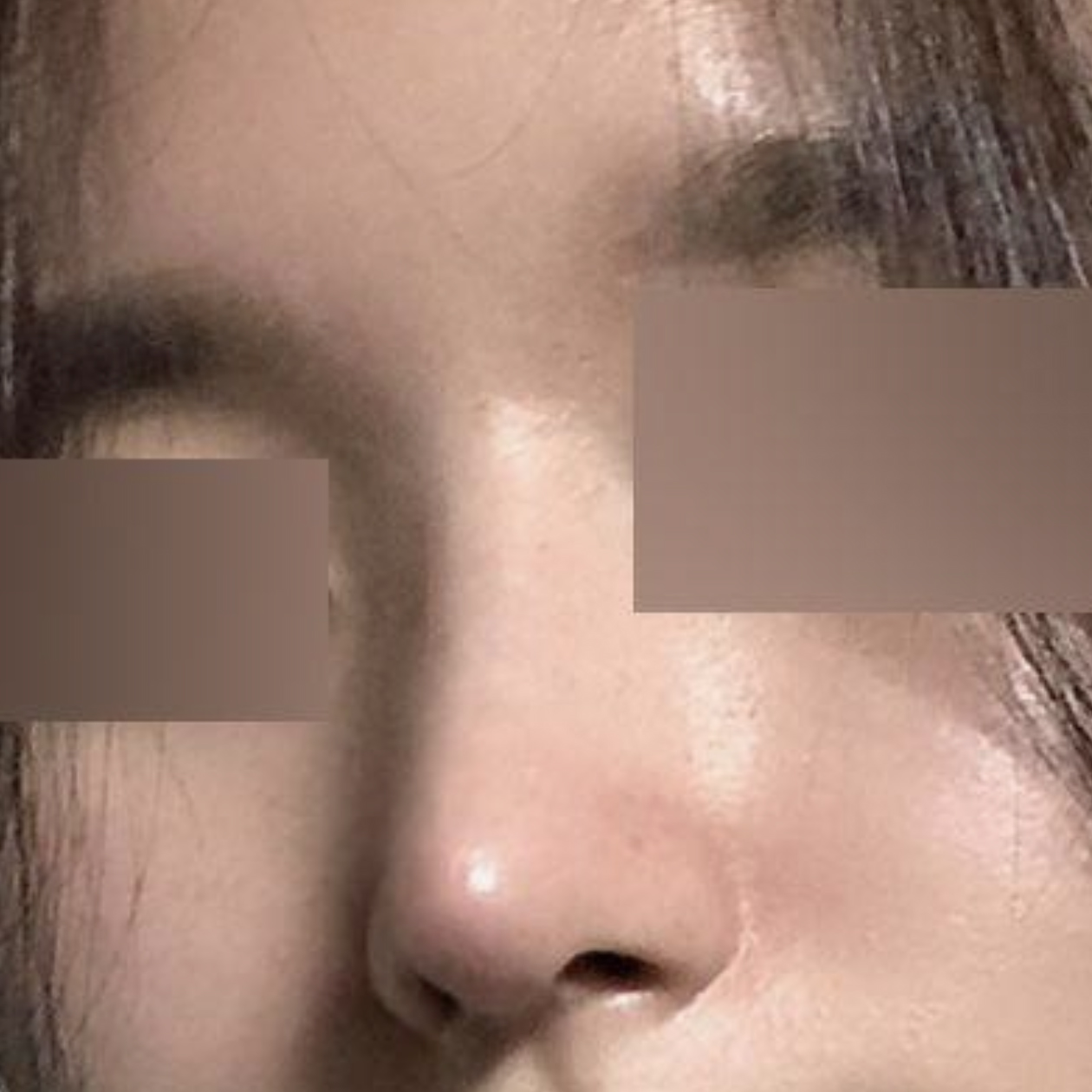 직반 라인으로 수술한지 2개월 됐습니다