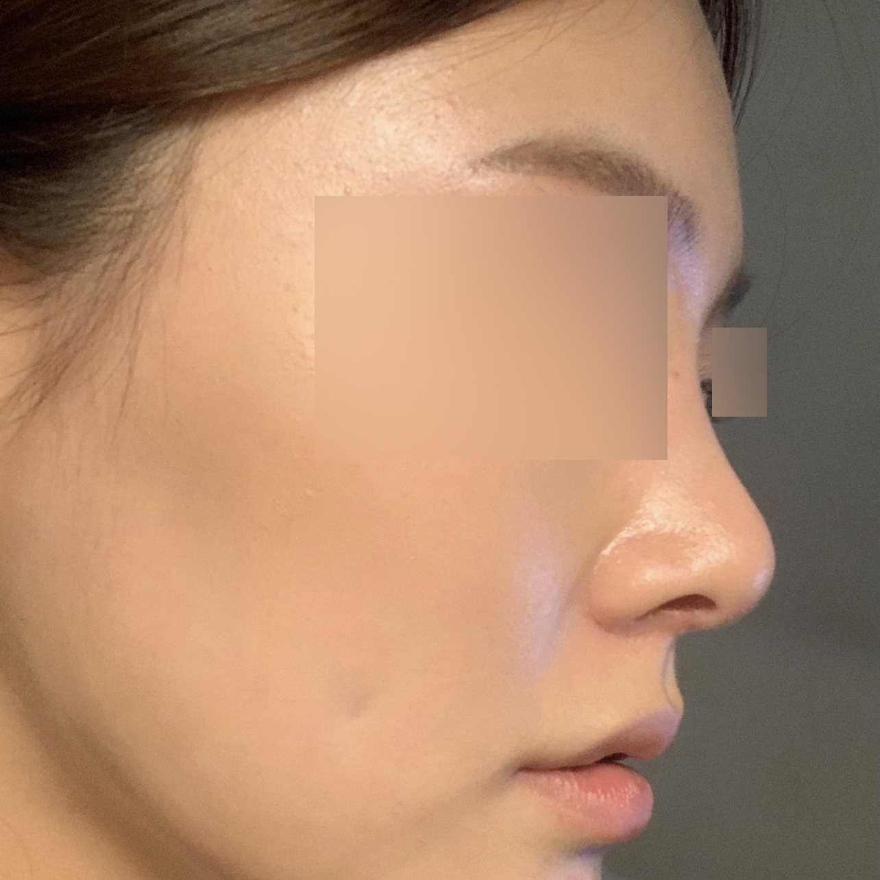 하이코랑은 비교가 안 되는 코 수술 두 달 차