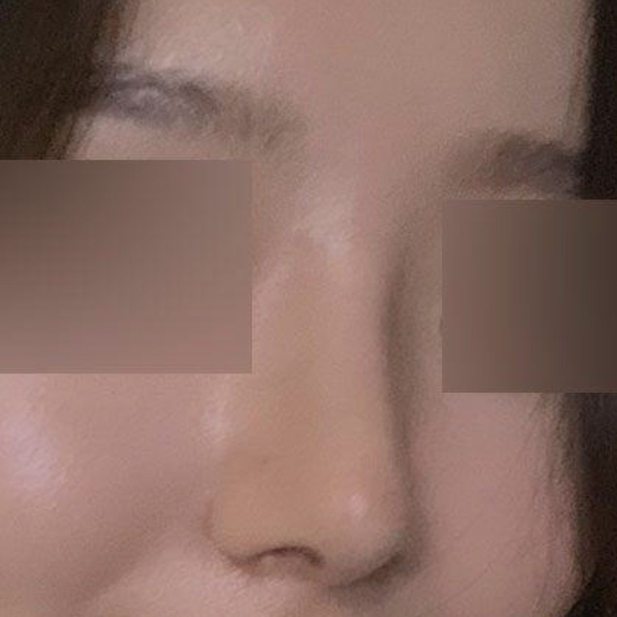 위버스에서 수술한지 드디어 2달 됐습니당