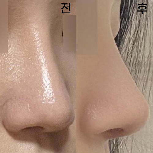 대표원장님께 코 재수술 받은지 벌써 1달이에요