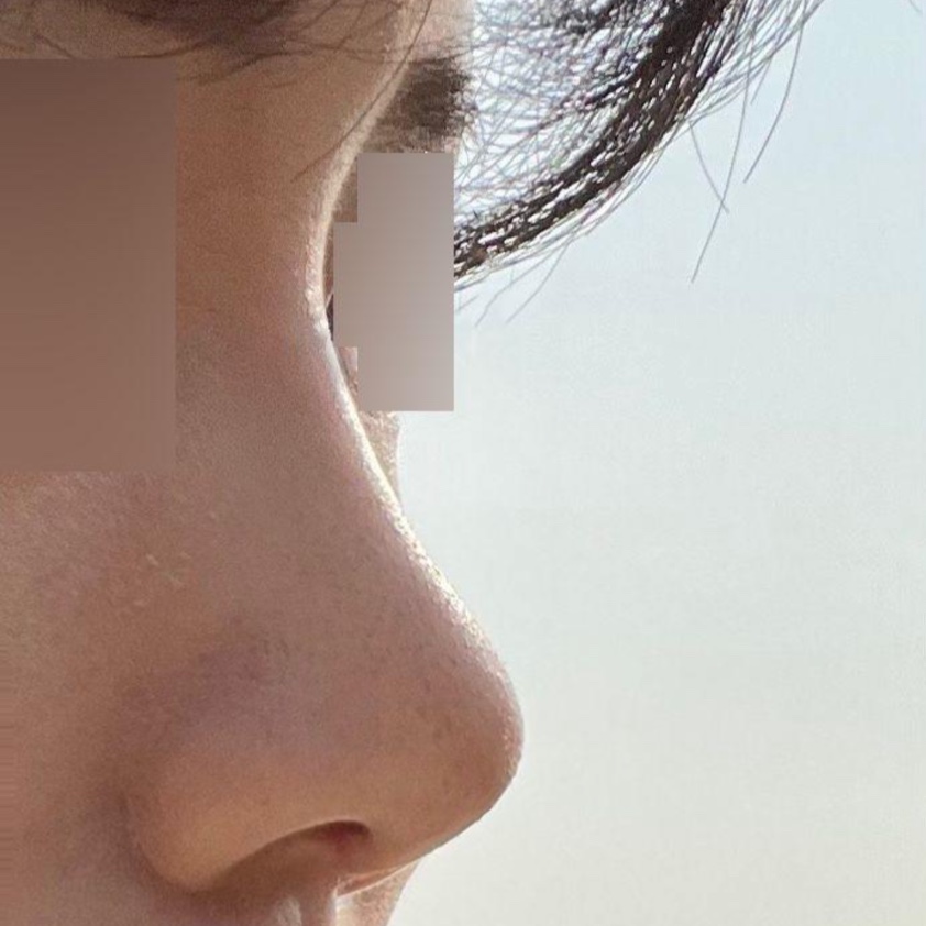 오늘 드디어 안쪽 실밥 제거하고왔어요!