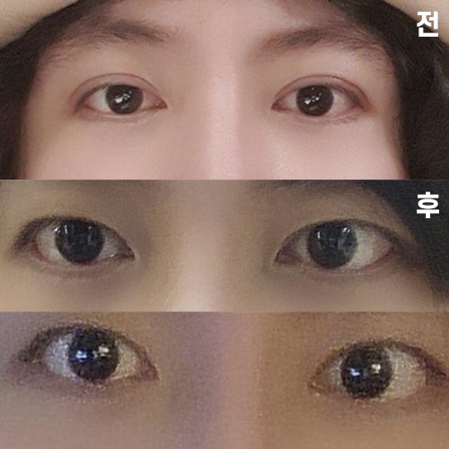 두줄따기 라인 낮추기 수술 후 경과 모습