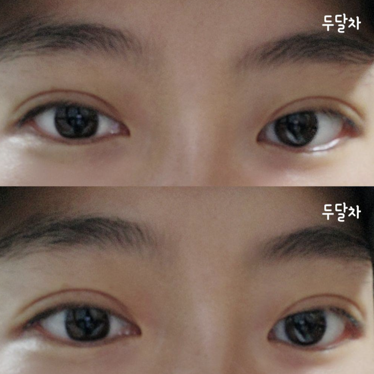 눈수술 두달차 찐후기입니다~^^