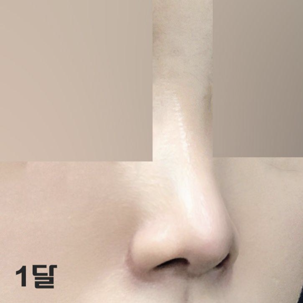 한달지나니까 더 붓기 쭉쭉 빠지는 것 같아영~