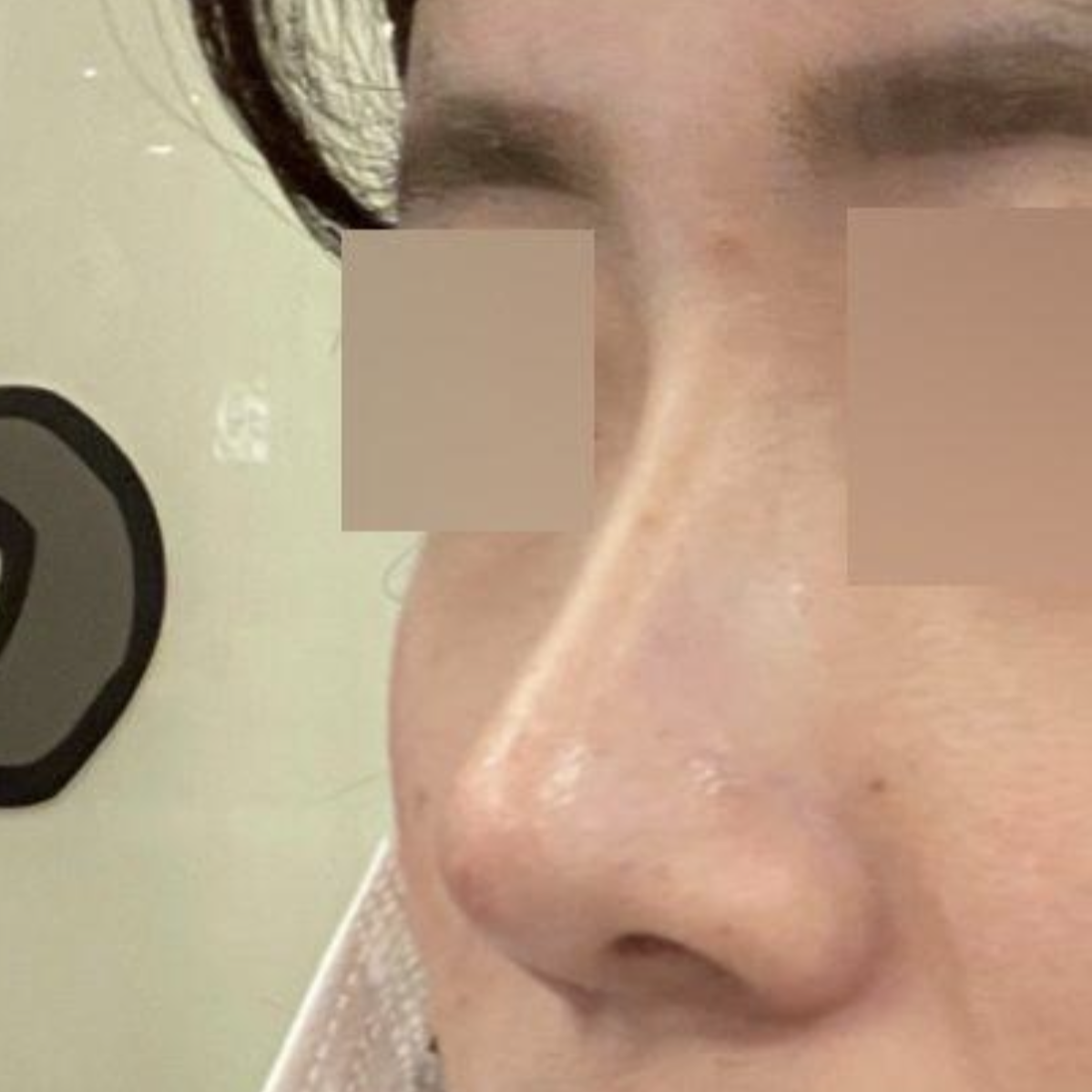 코수술 받은지 이제 두달 됐어요!