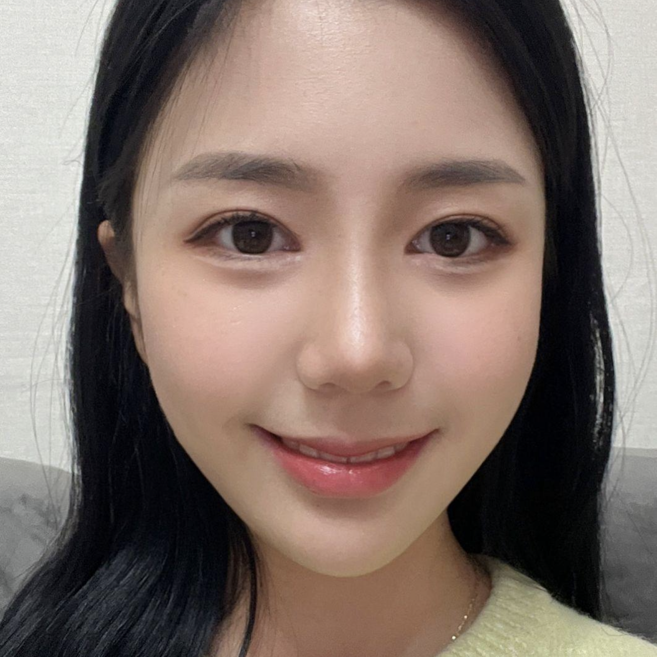 코성형, 눈재수술한지 3개월 지나가고 있어요