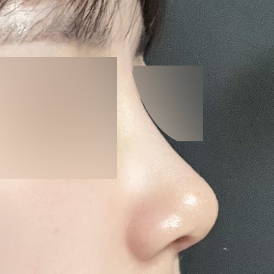 컴플렉스였던 코가 예뻐졌어요!