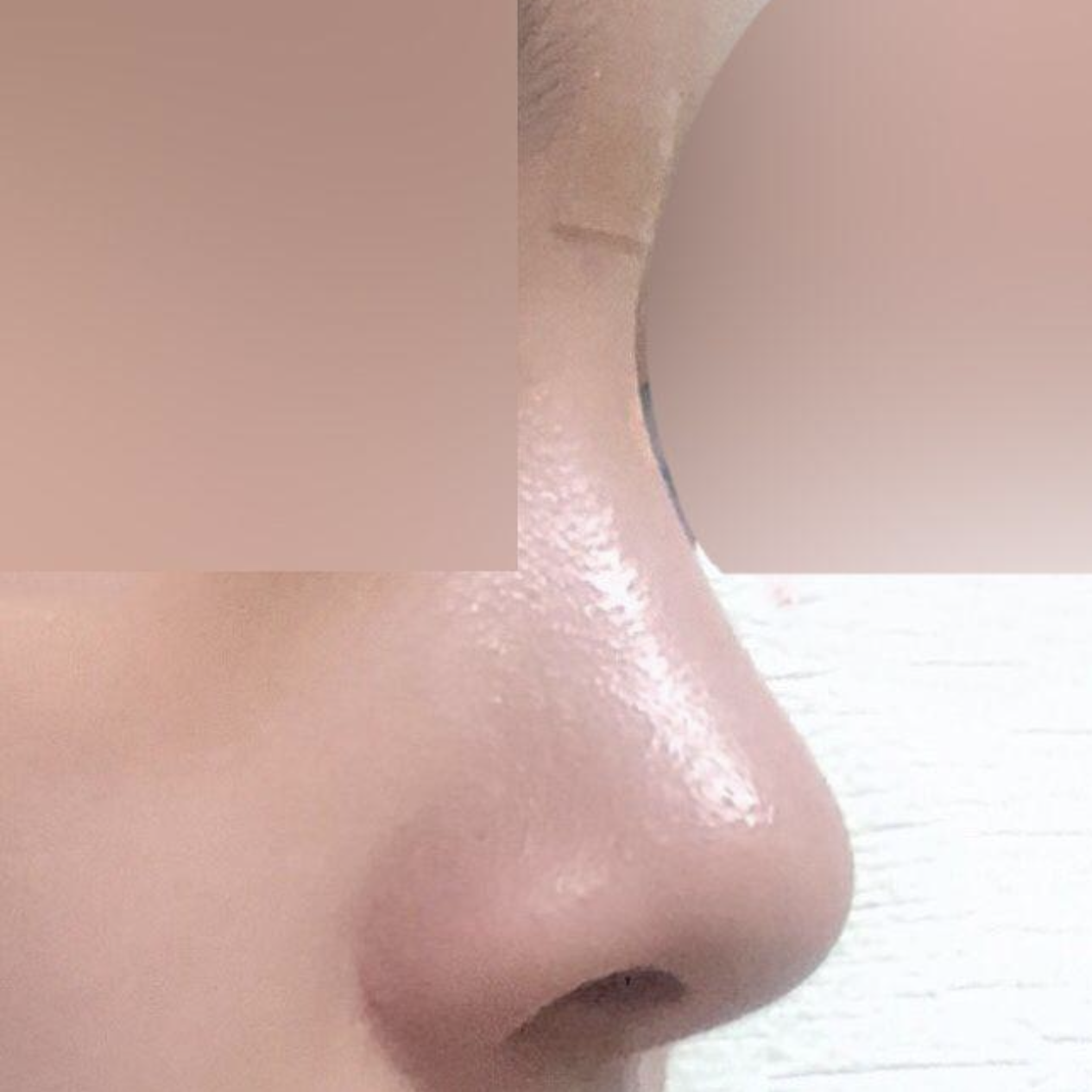 코 수술하고 3개월 후기에