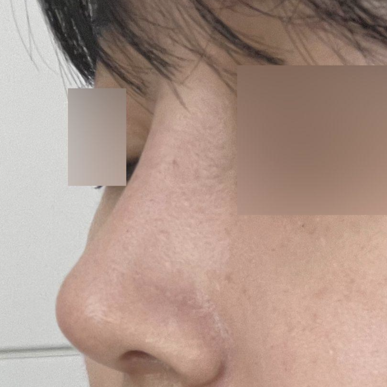 코 수술 한달차 성공했어요!