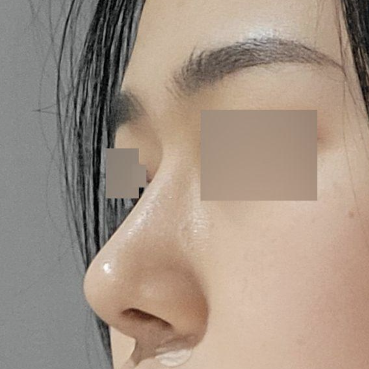 위버스에서 수술한지 5개월차입니다