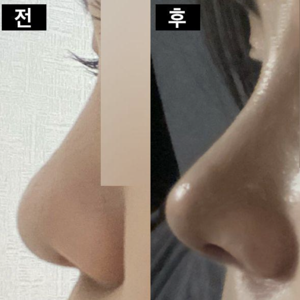 코수술한지 1달이나 됐네요 ㅎ