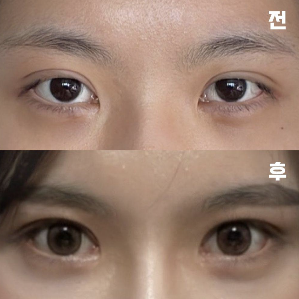 붓기 빠진 모습이 벌써부터 기대돼요