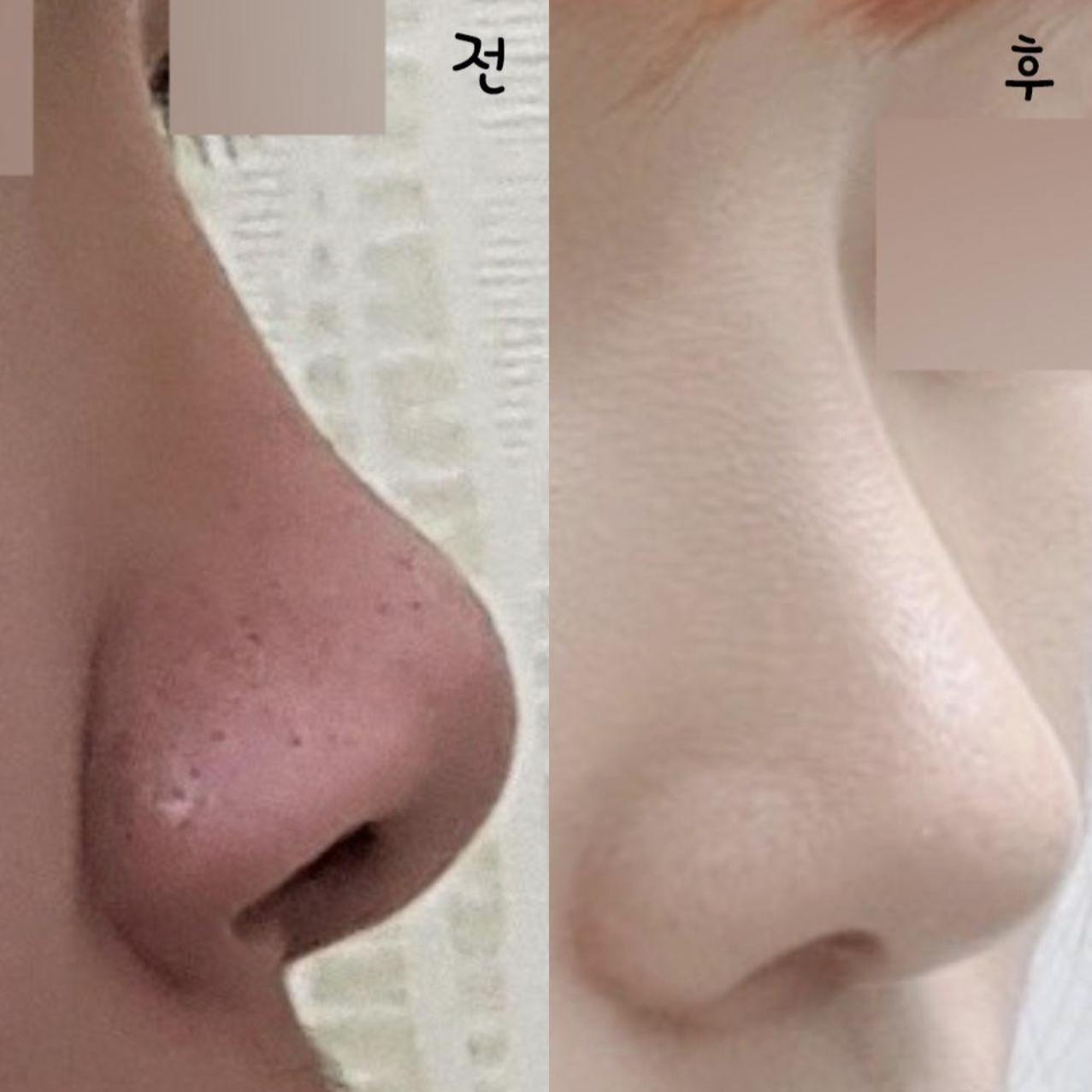 수술하고 자신감이 생겼어요!!