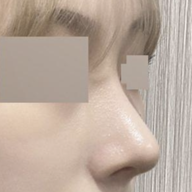 벌써 수술한지 2달차에여!!